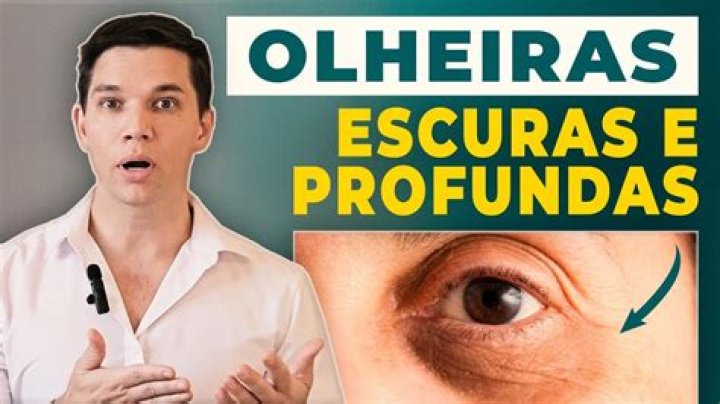 Como tirar olheiras escuras?