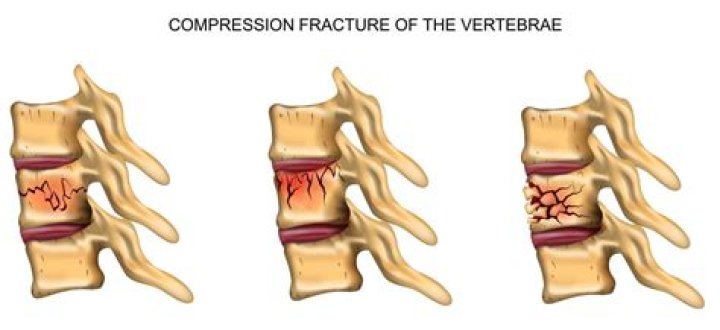 In compression bone fractures?