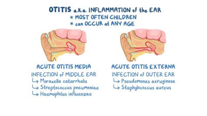 Is otitis externa acute?