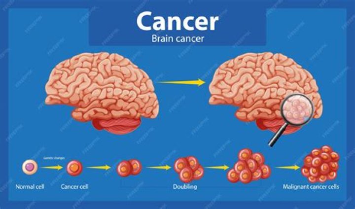 Quelle chance de survie avec un cancer du cerveau ?