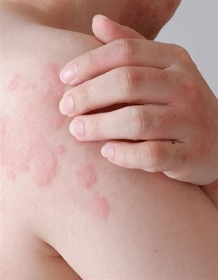 What are itchy welts?