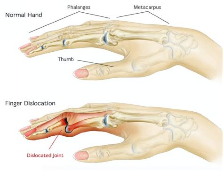 What does a dislocated thumb feel like?
