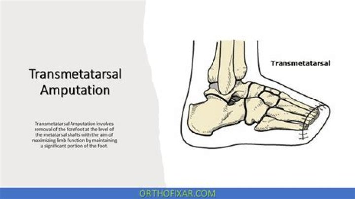 What is a transmetatarsal amputation?