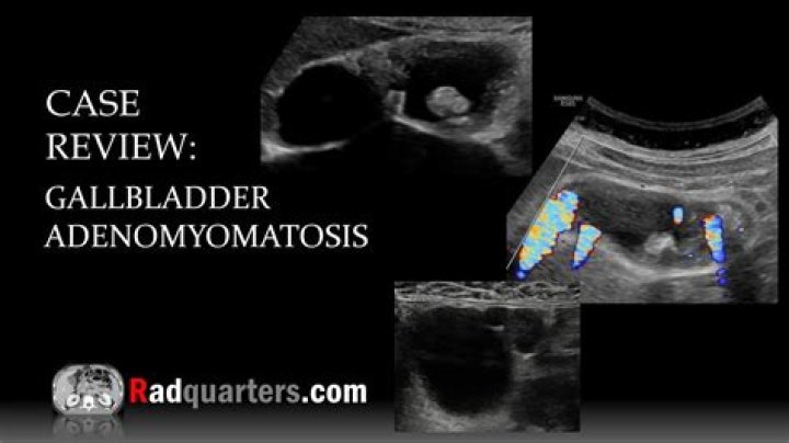 What is focal adenomyomatosis?