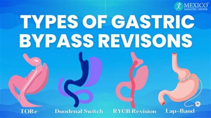 What medicine can you not take after gastric bypass?