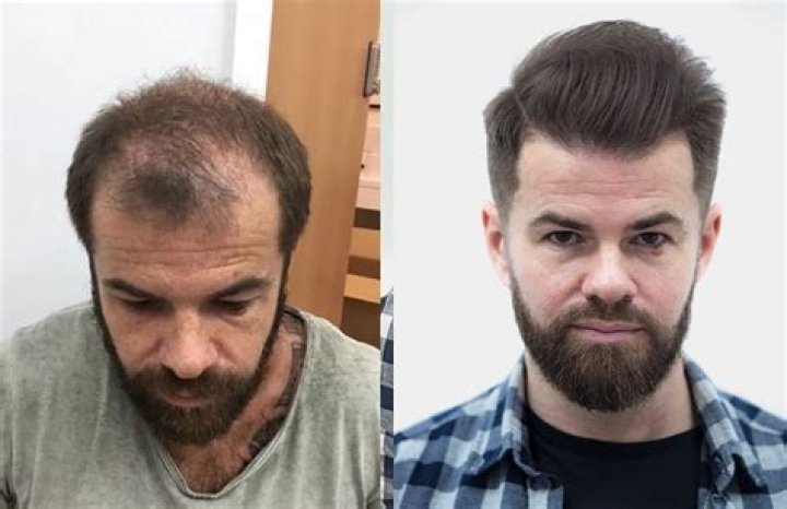 When prp after hair transplant?