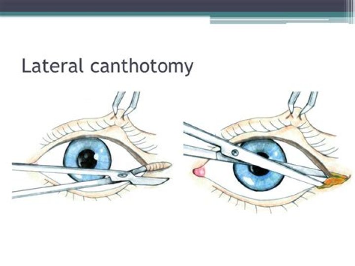 When to do lateral canthotomy?